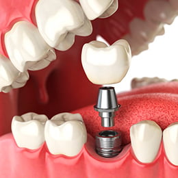 implantation Калькулятор